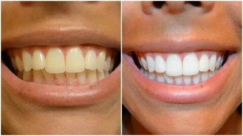 Tout ce que t’as besoin de savoir sur le blanchiment des dents : prix, techniques et astuces avec Sensodyne Blanchissant