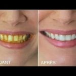 Comment Blanchir Naturellement les Dents : Le Guide Ultime pour un Sourire Éclatant