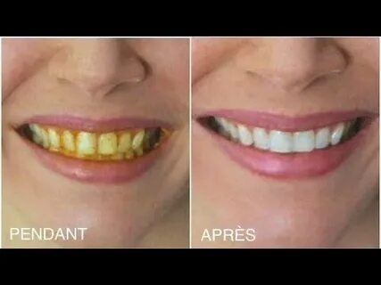 Comment Blanchir Naturellement les Dents : Le Guide Ultime pour un Sourire Éclatant