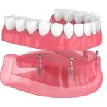 T’as perdu une dent ? Tout ce que tu dois savoir sur le pont fixe dentaire pour retrouver ton sourire