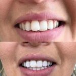 Douleurs gencives et dents : tout ce que vous devez savoir pour soulager la souffrance