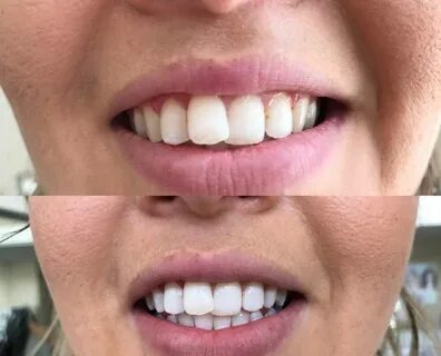 Douleurs gencives et dents : tout ce que vous devez savoir pour soulager la souffrance