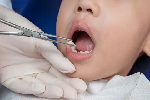 Tout ce que vous devez savoir sur une dent sensible au froid et son lien avec le prix des dents en or