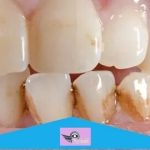Combien Coûte un Blanchiment Dentaire chez le Dentiste en 2025 ? Tout ce que Vous Devez Savoir !