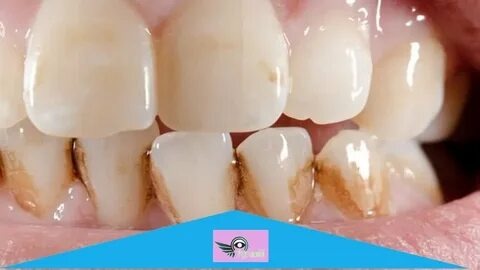 Combien Coûte un Blanchiment Dentaire chez le Dentiste en 2025 ? Tout ce que Vous Devez Savoir !