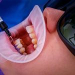 Prix du Blanchiment Dentaire chez le Dentiste : Tout ce que Vous Devez Savoir sur Opalescence Blanchiment 16 et Plus Encore