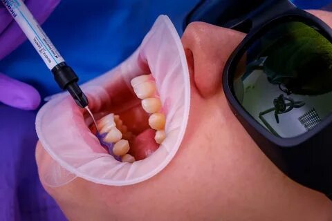 Prix du Blanchiment Dentaire chez le Dentiste : Tout ce que Vous Devez Savoir sur Opalescence Blanchiment 16 et Plus Encore