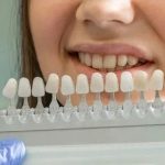 Tout ce que vous devez savoir sur le traitement blanchiment dentaire : Votre guide pour un sourire éclatant
