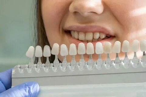 Tout ce que vous devez savoir sur le traitement blanchiment dentaire : Votre guide pour un sourire éclatant