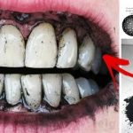 Tout ce que vous devez savoir sur le bicarbonate dentaire et son rôle dans le blanchiment des dents