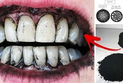 Tout ce que vous devez savoir sur le bicarbonate dentaire et son rôle dans le blanchiment des dents