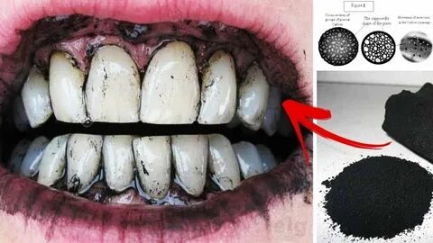 Tout ce que vous devez savoir sur le bicarbonate dentaire et son rôle dans le blanchiment des dents