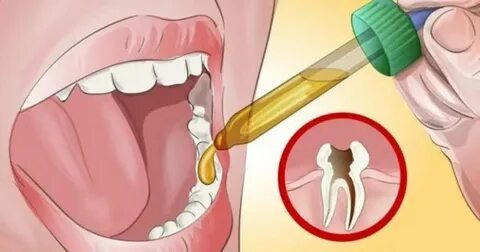 T’as mal aux dents ? Tout ce que tu dois savoir sur la douleur carie dentaire pour arrêter de souffrir