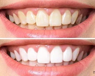 Gencive douloureuse et gonflée : que faire pour soulager et prévenir ?