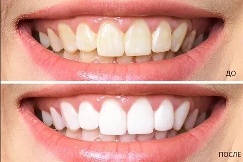 Gencive douloureuse et gonflée : que faire pour soulager et prévenir ?