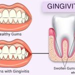 Tout ce que vous devez savoir sur les gingivites : un guide complet pour une bouche en santé