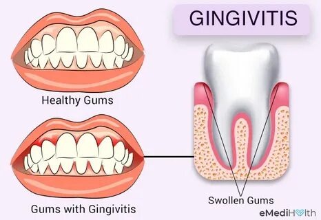 Tout ce que vous devez savoir sur les gingivites : un guide complet pour une bouche en santé
