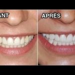 traitement pour blanchir les dents