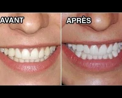 traitement pour blanchir les dents