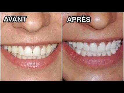 traitement pour blanchir les dents