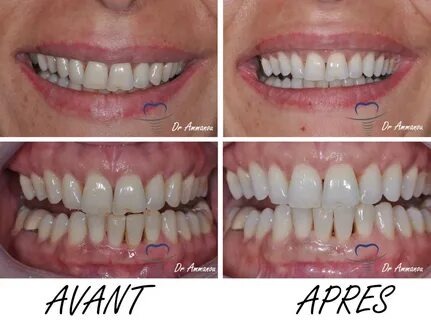 Blanchissant pour les dents : comment retrouver un sourire éclatant sans abîmer vos gencives