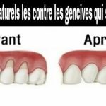 Pourquoi tes gencives te font mal ? Les causes possibles