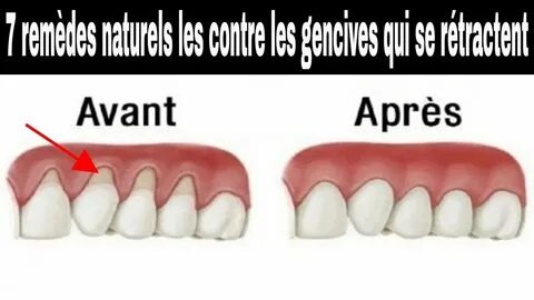 Pourquoi tes gencives te font mal ? Les causes possibles