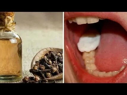 Comment soulager une rage de dent avec le clou de girofle : votre guide ultime pour un remède naturel
