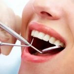 Tout ce que vous devez savoir sur le blanchiment dentaire au laser : Un sourire éclatant à portée de main