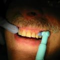 Comment blanchir tes dents avec un dentiste et briller avec allo dent