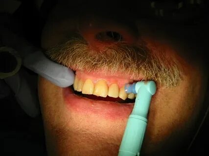 Comment blanchir tes dents avec un dentiste et briller avec allo dent