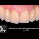 Spedifen et mal de dents : Comment ça marche et quoi savoir ?
