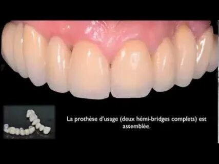 Spedifen et mal de dents : Comment ça marche et quoi savoir ?
